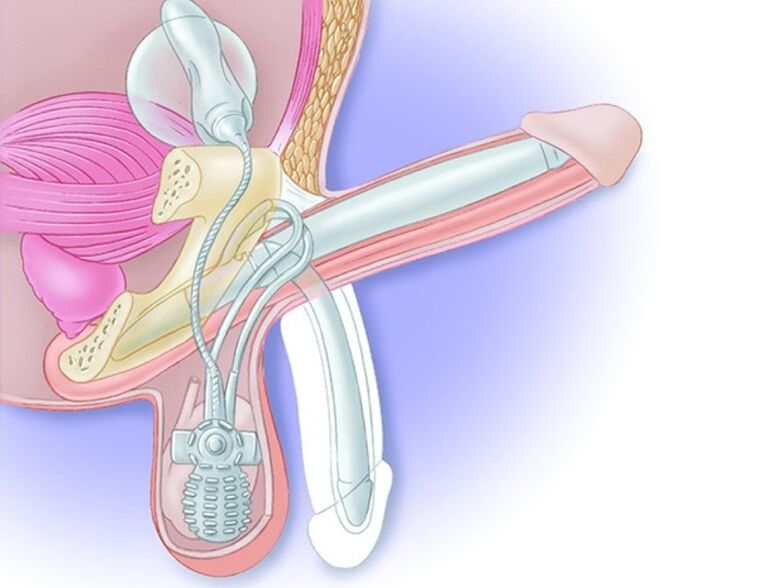 penile prostheses to increase potency after 60 years